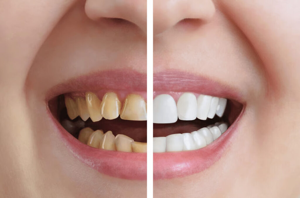 Teeth Whitening